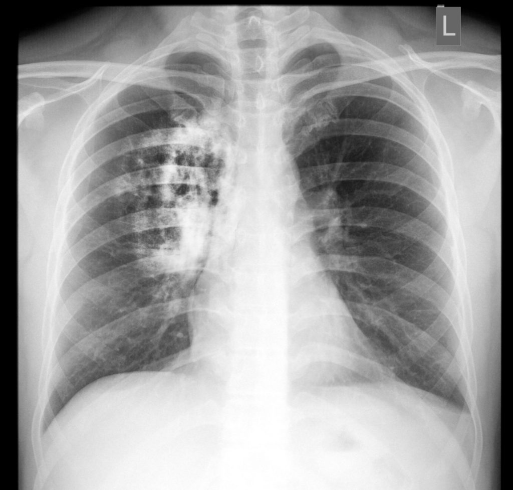 Lung x-ray pneumonia