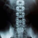 X-Ray Image Of Human Chest for a medical diagnosis. Concept of what neck problems quality for disability